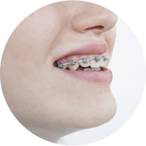 矯正器具が目立って恥ずかしい